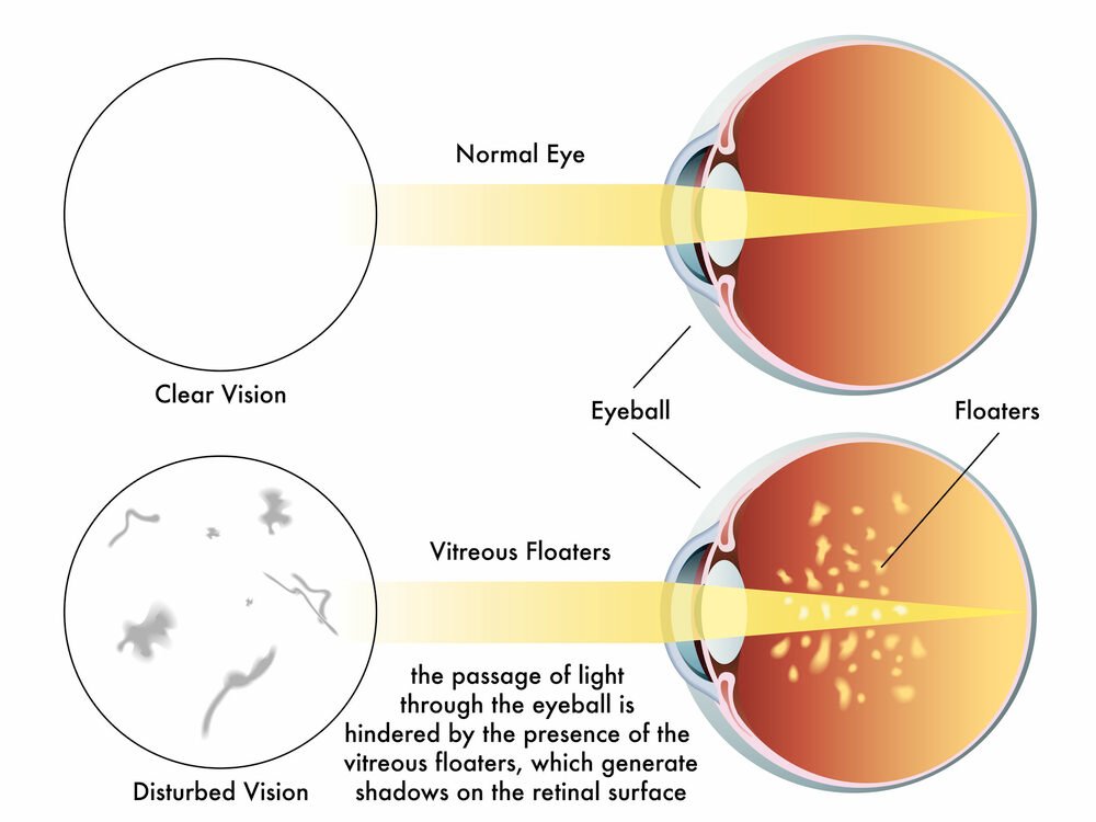 Understanding Eye Floaters: Causes and Treatment Options