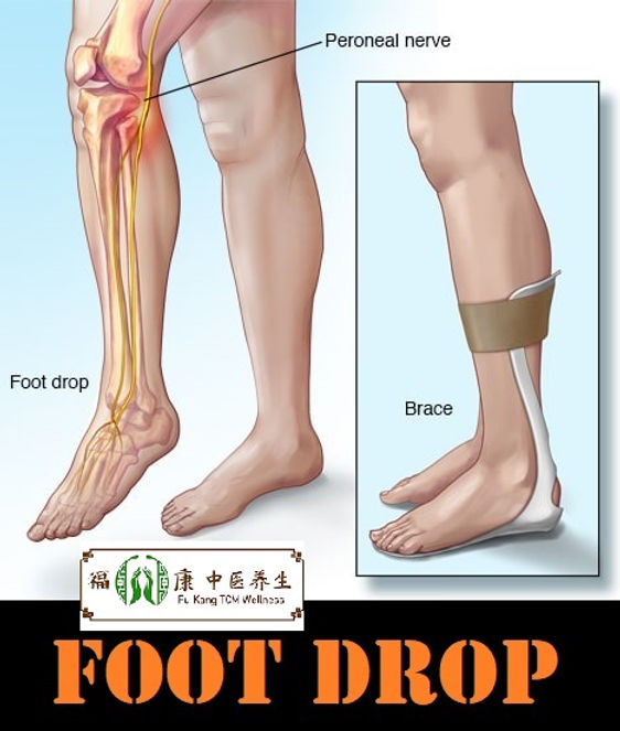 Understanding Foot Drop