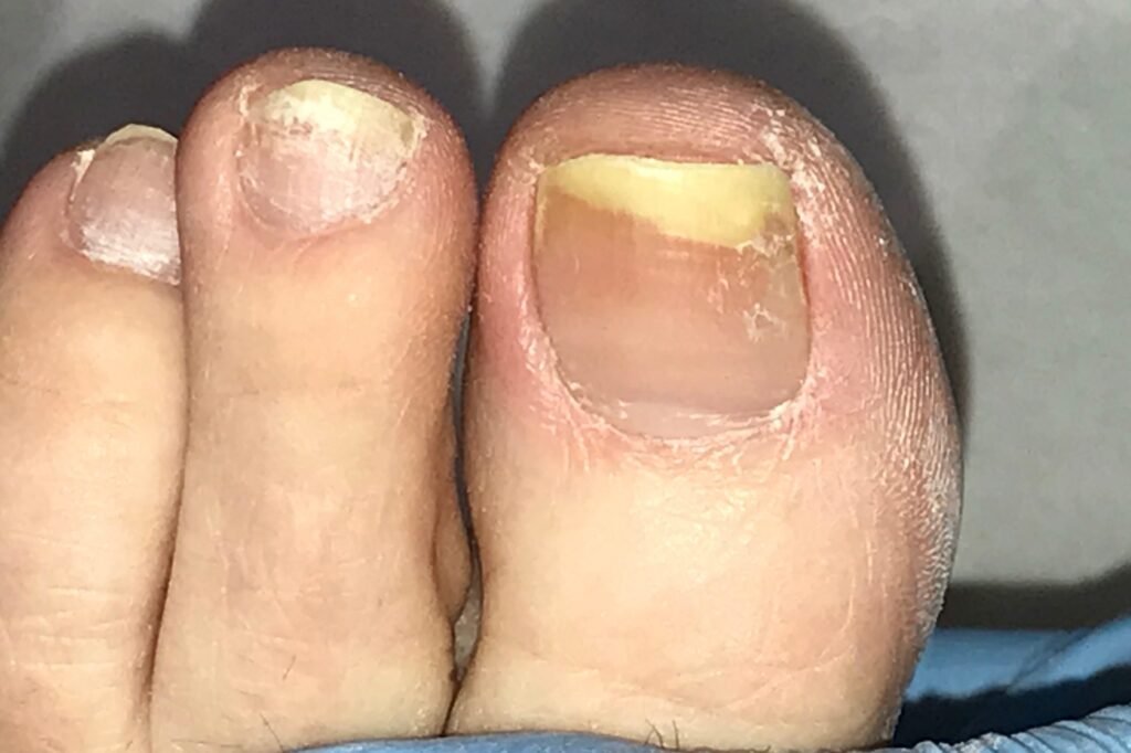 Understanding Fungal Nail Infections