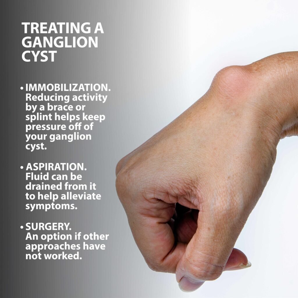 Understanding Ganglion Cysts Causes Symptoms And Treatment Ask The 