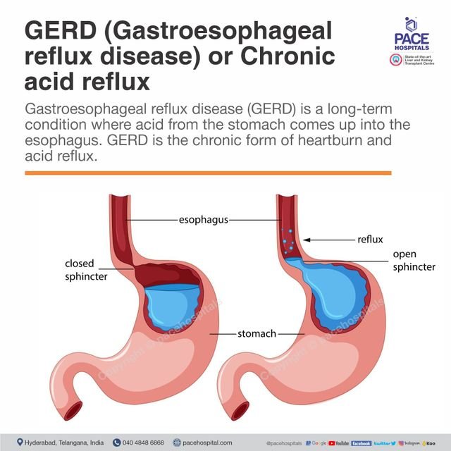 Understanding Gastro-oesophageal Reflux Disease