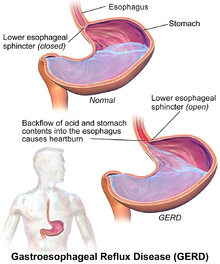 Understanding Gastro-oesophageal Reflux Disease