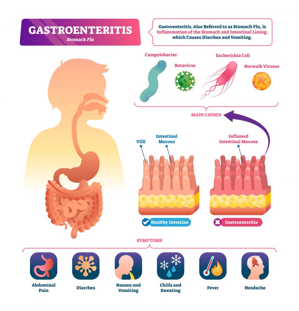 Understanding Gastroenteritis: Causes, Symptoms, and Treatment