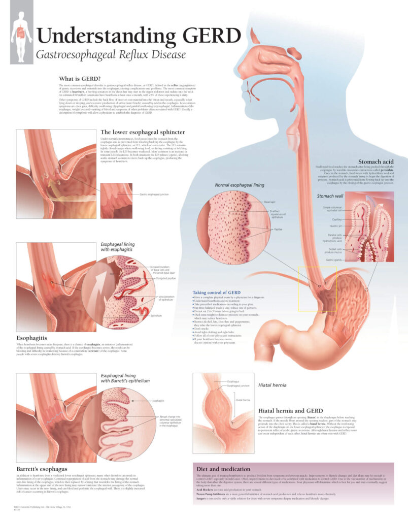Understanding Gastroesophageal Reflux Disease