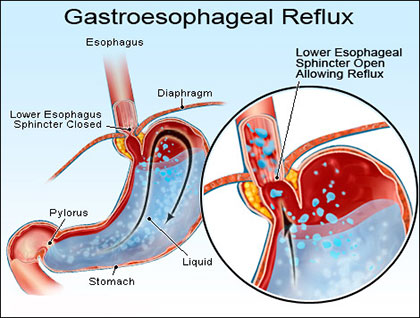 Understanding Gastroesophageal Reflux Disease (GERD)