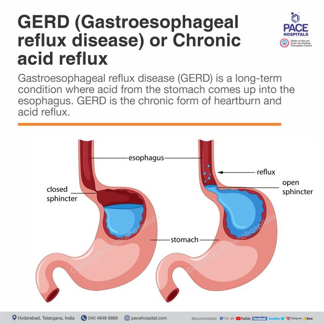 Understanding Gastroesophageal Reflux Disease