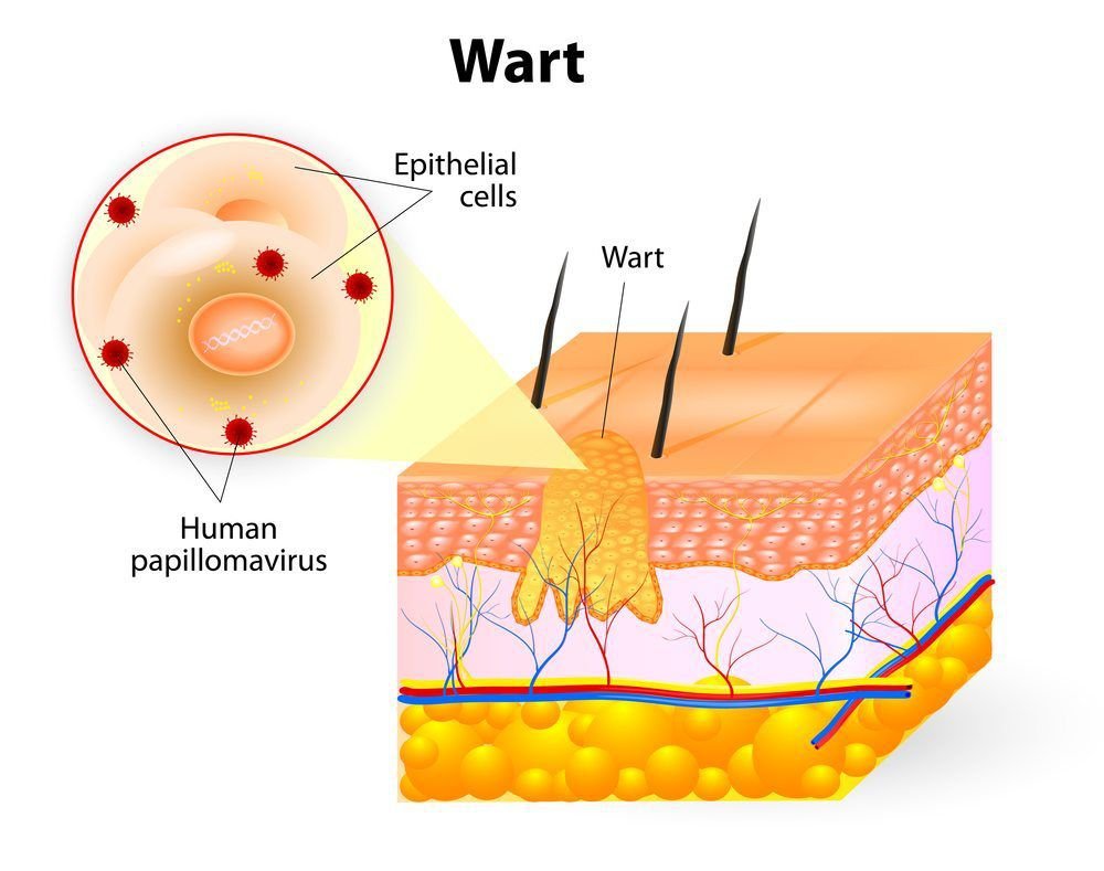 Understanding Genital Warts: Causes, Symptoms, and Treatment