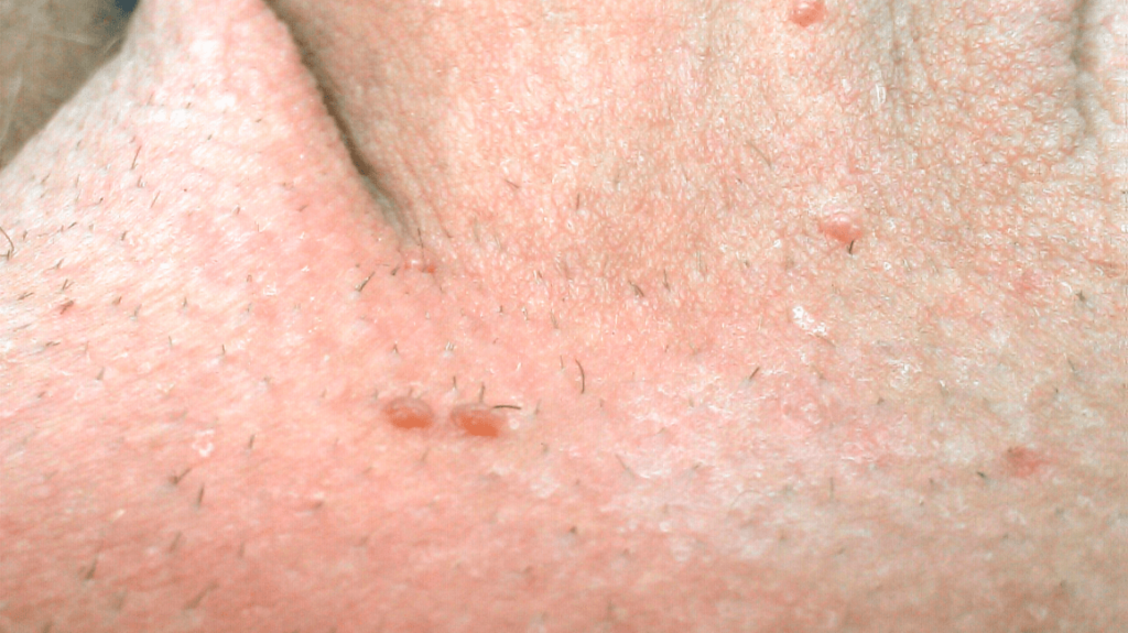 Understanding Genital Warts: Symptoms, Causes, and Treatment