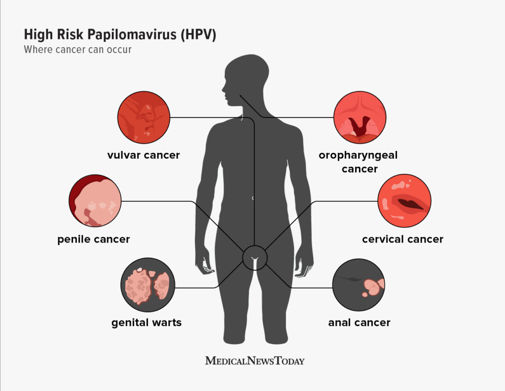 Understanding Genital Warts: Symptoms, Causes, and Treatment