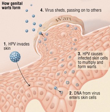 Understanding Genital Warts: Symptoms, Causes, and Treatment