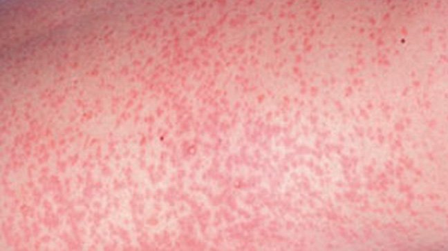 Understanding German Measles: Symptoms, Causes, and Treatment
