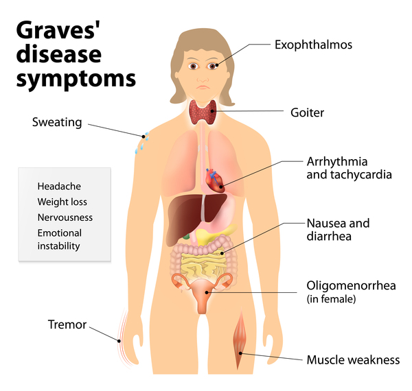 Understanding Graves Disease