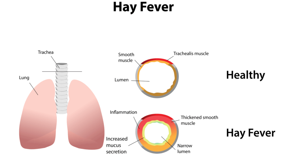 Understanding Hay Fever: Causes, Symptoms, and Treatment Options
