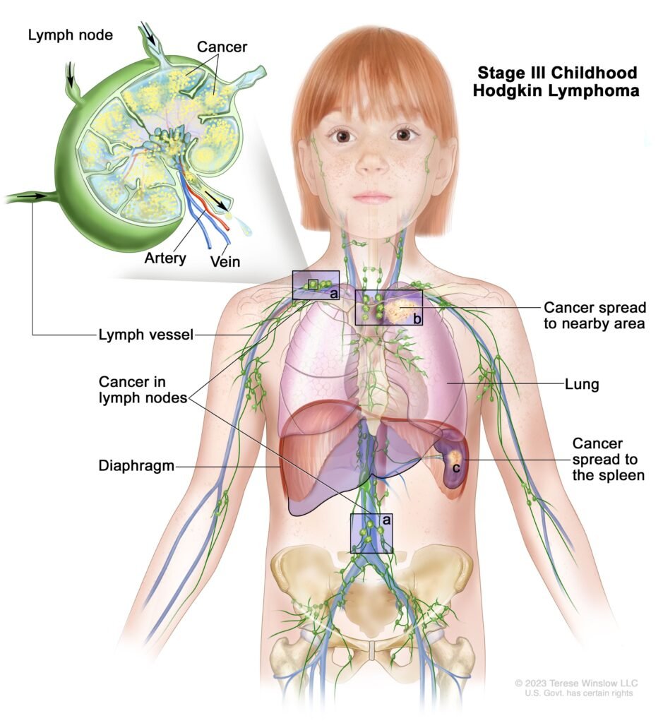 Understanding Hodgkin Lymphoma in Children