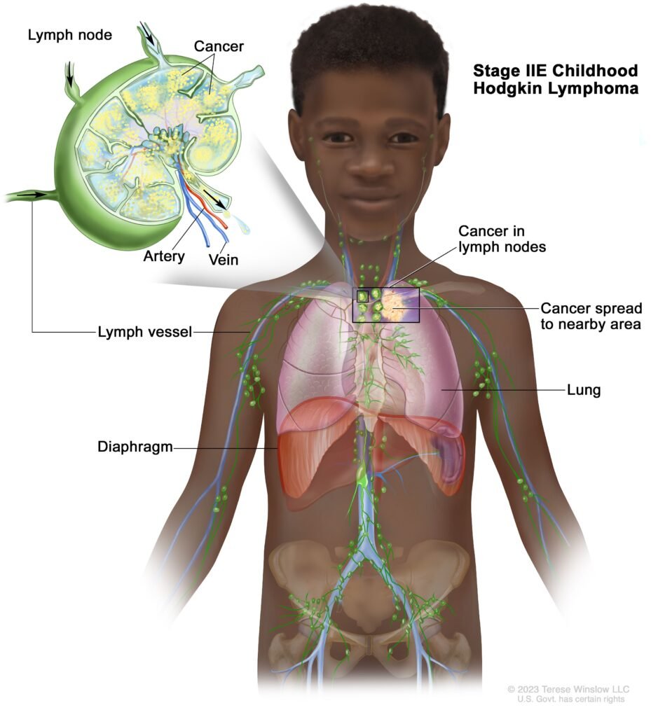 Understanding Hodgkin Lymphoma in Children