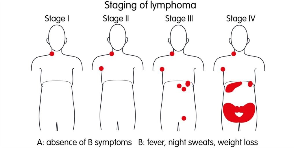 Understanding Hodgkin Lymphoma in Children
