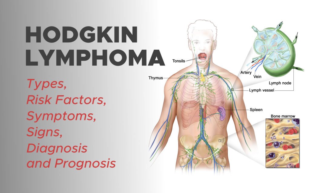 Understanding Hodgkins Lymphoma