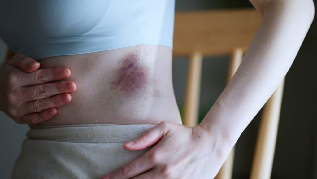 Understanding Internal Bleeding