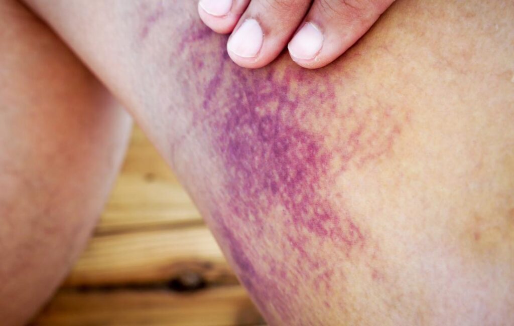 Understanding Internal Bleeding