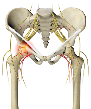 Understanding Irritable Hip Syndrome in Adults