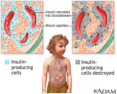 Understanding Juvenile Diabetes