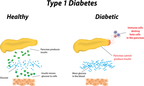Understanding Juvenile Diabetes
