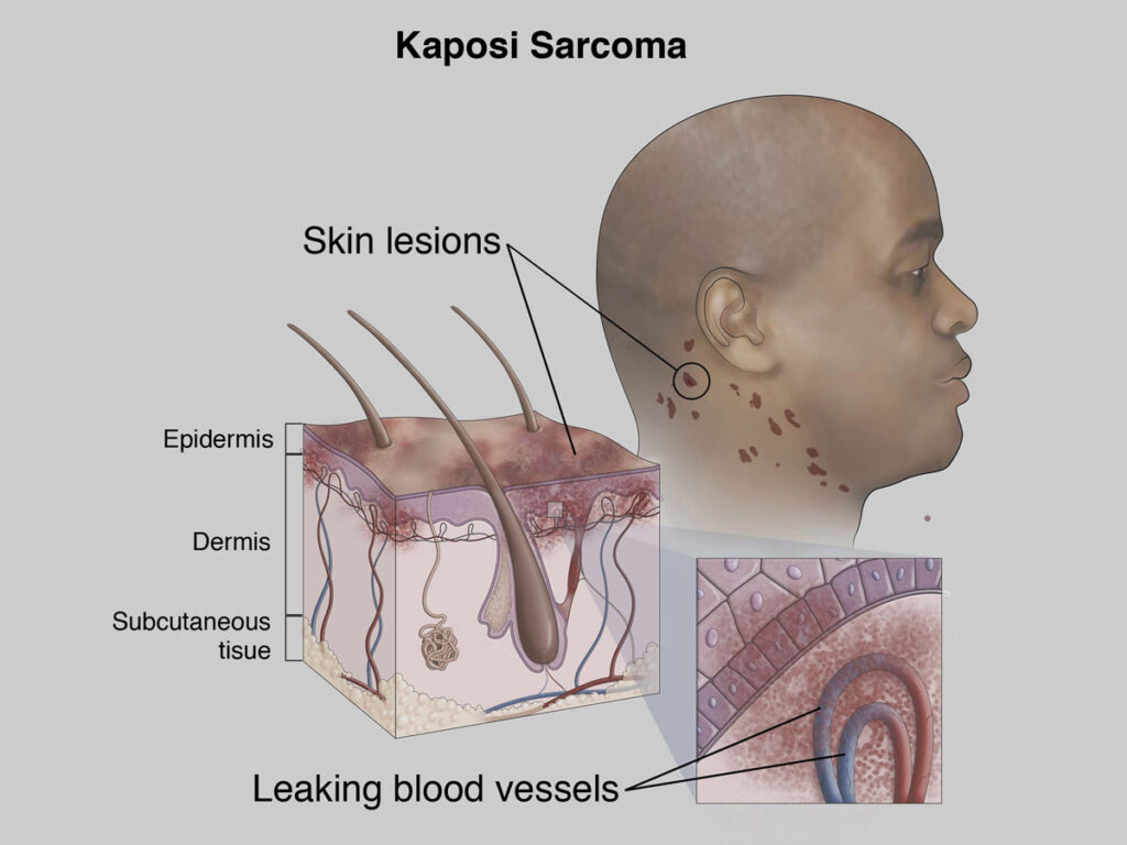 Understanding Kaposis Sarcoma: Causes, Symptoms, and Treatment