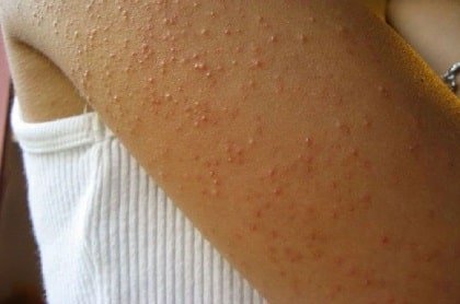 Understanding Keratosis Pilaris: Causes, Symptoms, and Treatment Options