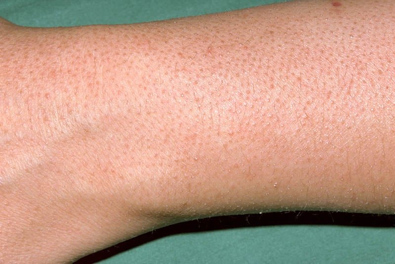 Understanding Keratosis Pilaris: Causes, Symptoms, and Treatment Options