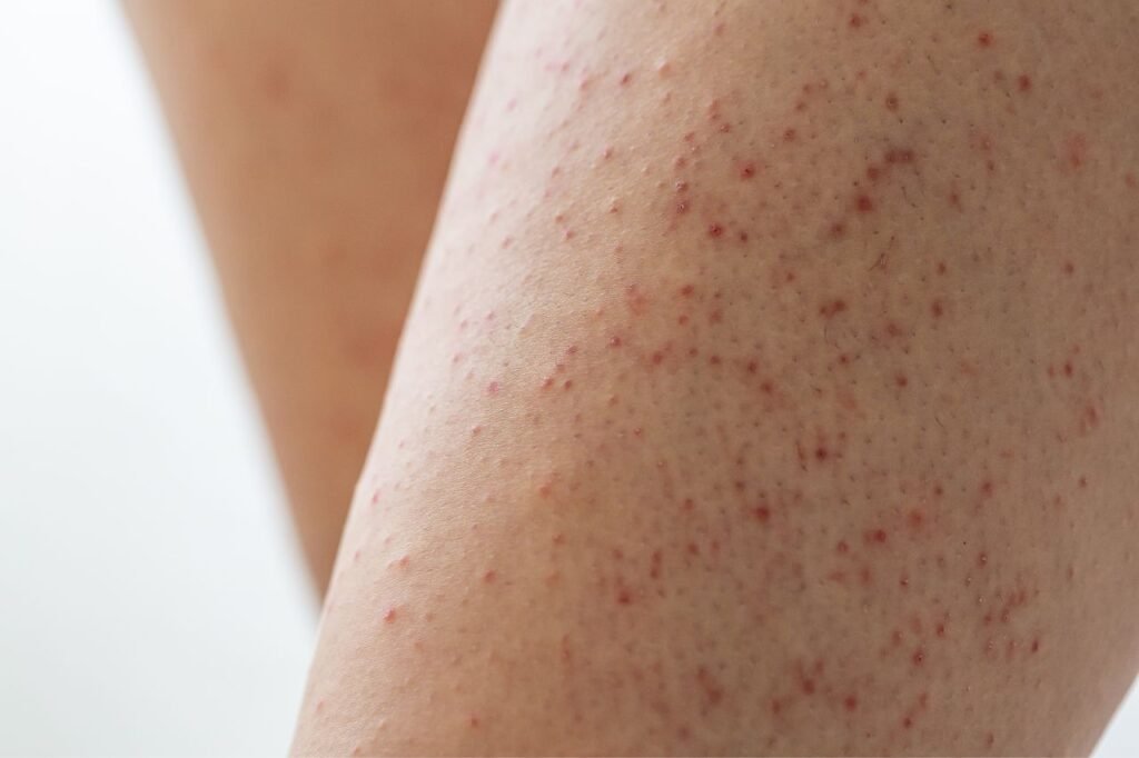 Understanding Keratosis Pilaris: Causes, Symptoms, and Treatment Options