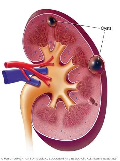 Understanding Kidney Cysts