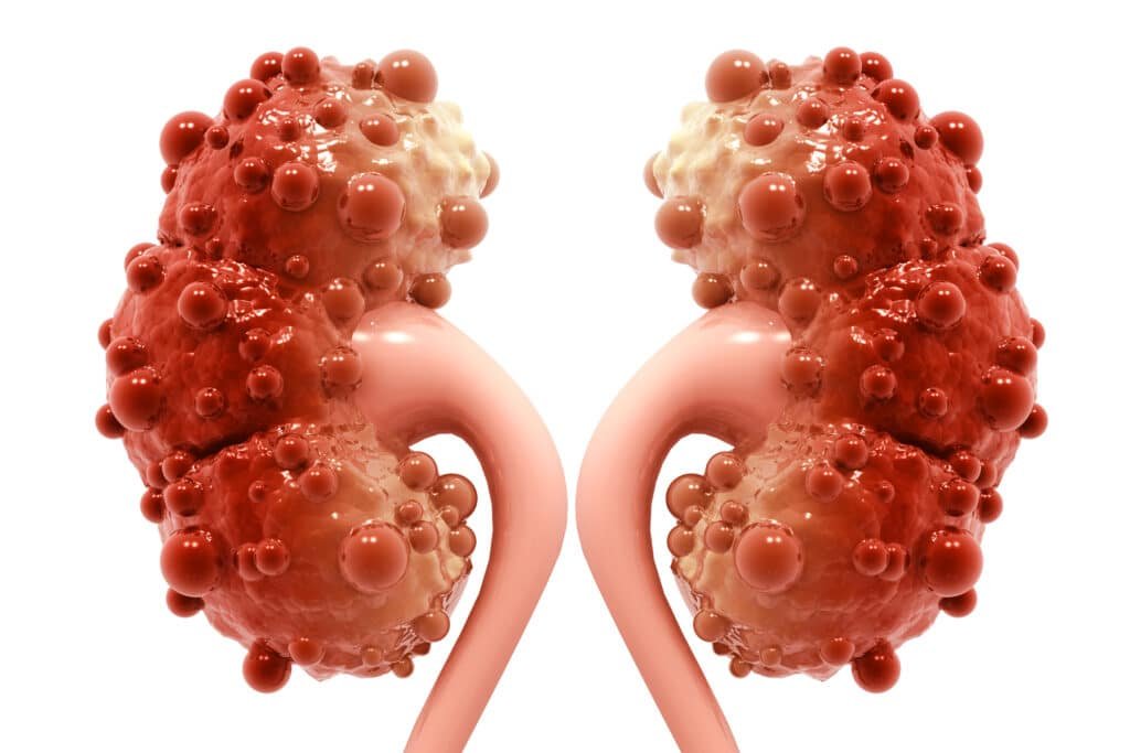 Understanding Kidney Cysts