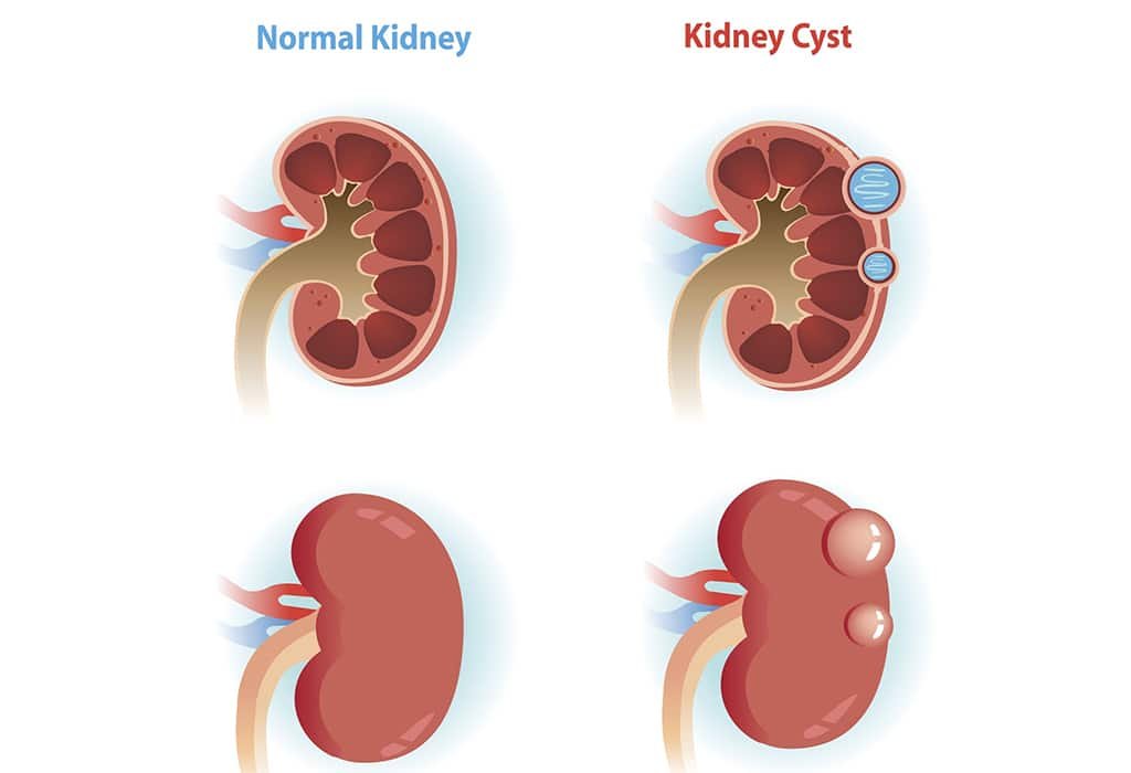 Understanding Kidney Cysts