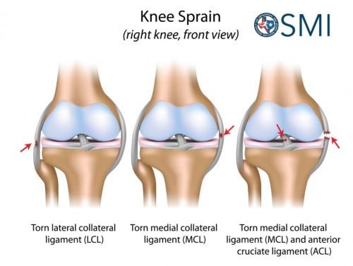 Understanding Knee Injuries