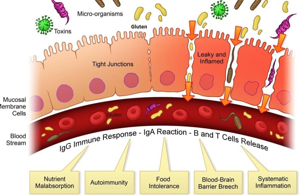 Understanding Leaky Gut Syndrome