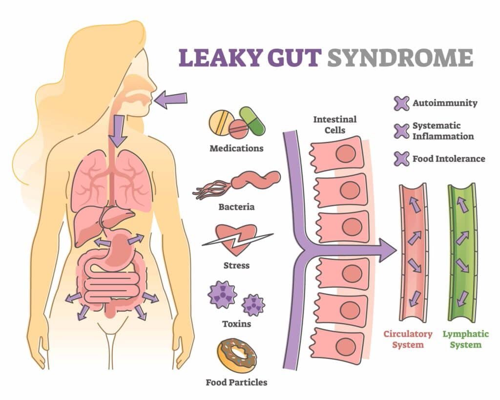 Understanding Leaky Gut Syndrome