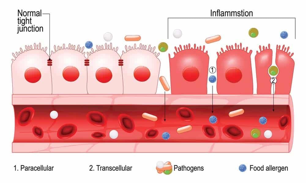 Understanding Leaky Gut Syndrome