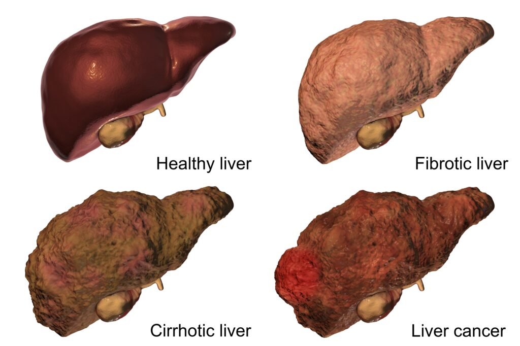 Understanding Liver Cancer