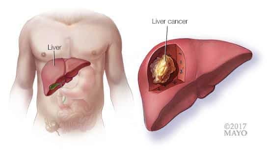 Understanding Liver Cancer