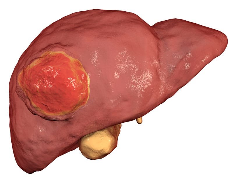 Understanding Liver Tumors