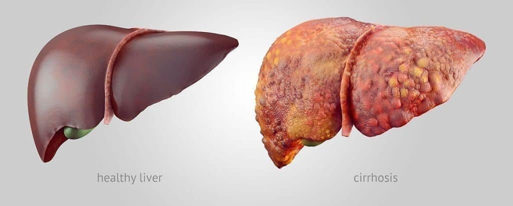 Understanding Liver Tumors