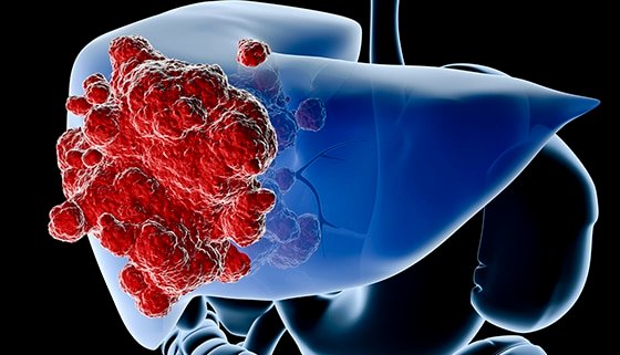 Understanding Liver Tumors
