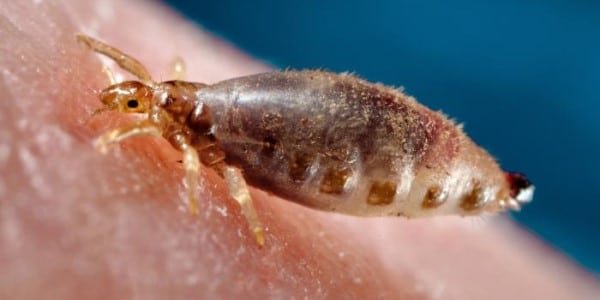 Understanding Louse Borne Relapsing Fever: Causes and Symptoms