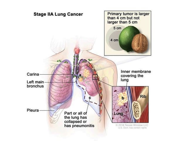 Understanding Lung Cancer