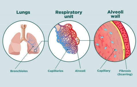 Understanding Lung Disease