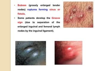 Understanding Lymphogranuloma Venereum (LGV)