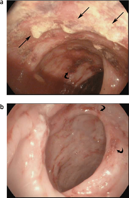 Understanding Lymphogranuloma Venereum (LGV)