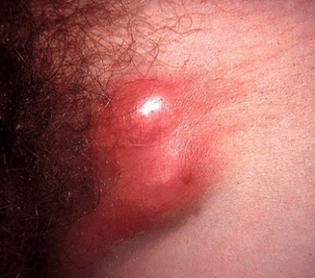Understanding Lymphogranuloma Venereum (LGV)