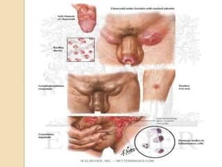 Understanding Lymphogranuloma Venereum (LGV)