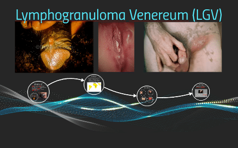 Understanding Lymphogranuloma Venereum (LGV)